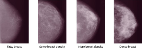 Understanding Breast Density - The Pink Journey Foundation